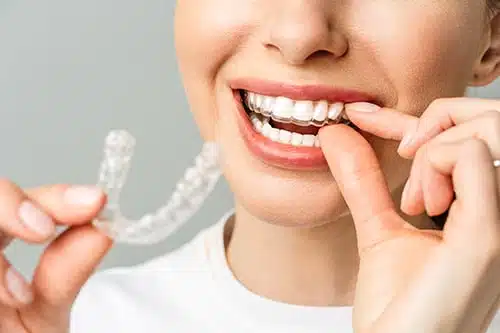 young-woman-aligners-min