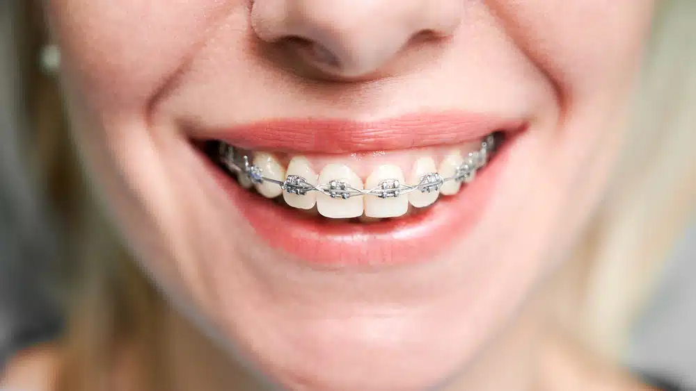 Exploring-Types-of-Braces-Pros-and-Cons